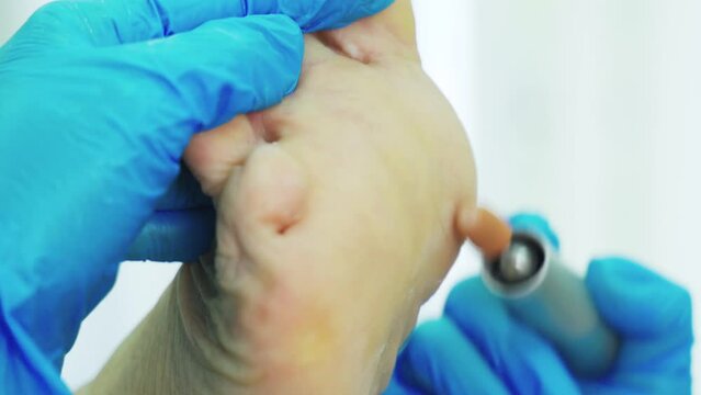Treatment of nails and feet. An orthopedic doctor treats calluses on the foot.