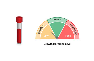 Growth hormone level. Somatotropin. Dwarfism and Acromegaly. Vector illustration. - obrazy, fototapety, plakaty