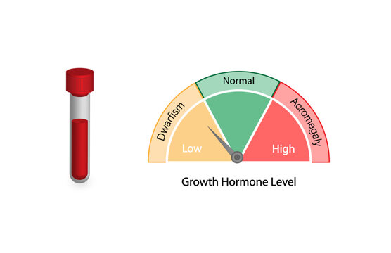 Growth hormone level. Somatotropin. Dwarfism and Acromegaly. Vector illustration.