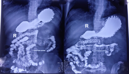 Barium swallow of oesophagus examination x-ray. showing upper digestive system. Oesophagus, mucosal...