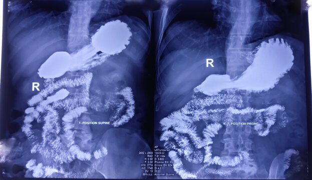 Barium swallow of oesophagus examination x-ray. showing upper digestive system. Oesophagus, mucosal pattern of oesophagus, Normal findings.