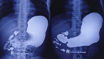 Barium swallow of oesophagus examination x-ray. showing upper digestive system. Oesophagus, mucosal pattern of oesophagus, Normal findings. - obrazy, fototapety, plakaty