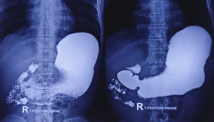 Foto op Canvas Barium swallow of oesophagus examination x-ray. showing upper digestive system. Oesophagus, mucosal pattern of oesophagus, Normal findings. © MdBabul