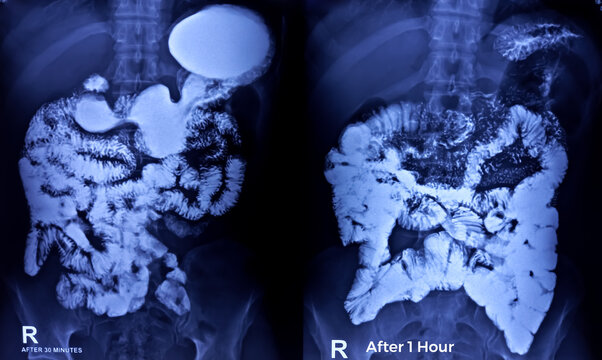 Barium swallow of oesophagus examination x-ray. showing upper digestive system. Oesophagus, mucosal pattern of oesophagus, Normal findings.