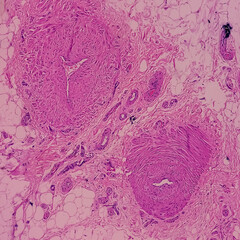 Distal femur (biopsy): Exostosis. Section show mature hyaline cartilage with overlying fibrous...