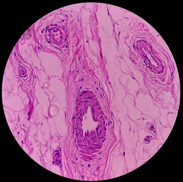 Distal femur (biopsy): Exostosis. Section show mature hyaline cartilage with overlying fibrous perichondrium.