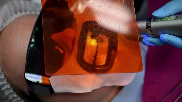 Dental Whitening process in patient mouth. Teeth whitening with UF Lamp, Led Lamp and gel. Dental Extreme Close up Macro Video. Concept of professional dental hygiene. 4k 120 fps slow motion footage