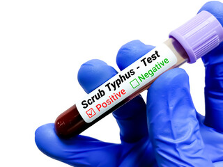 Obraz premium Scrub Typhus blood test positive with white background.