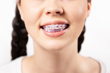 Close up of young Caucasian woman with brackets on teeth and orthodontic wax covering one ligature brace. White background. Concept of dental care during orthodontic treatment - obrazy, fototapety, plakaty