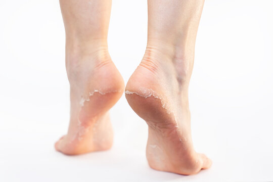 Rear view of female feet with peeling skin on heels, on white background. Skin care and peeling leg's soles