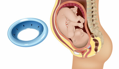 Gynecological and obstetric pessary. Cervical pessary in pregnant women with a short cervix. Modeling of effective positioning of Arabin cerclage pessary in women at high risk of preterm birth. - obrazy, fototapety, plakaty