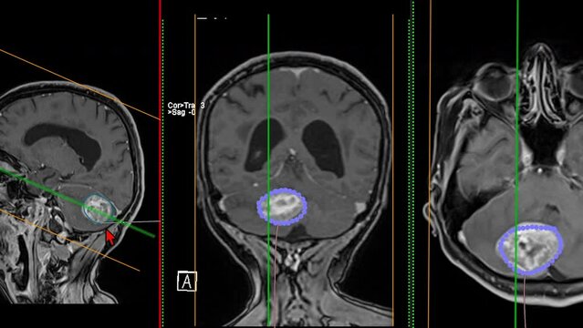Brain magnetic resonance imaging shows the area around the brain tumor.