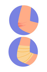 Types of bandages set. Swathe for cure elbow. Health care and treatment, medicine. Cut and wound. Educational materials. Cartoon flat vector collection isolated on white background