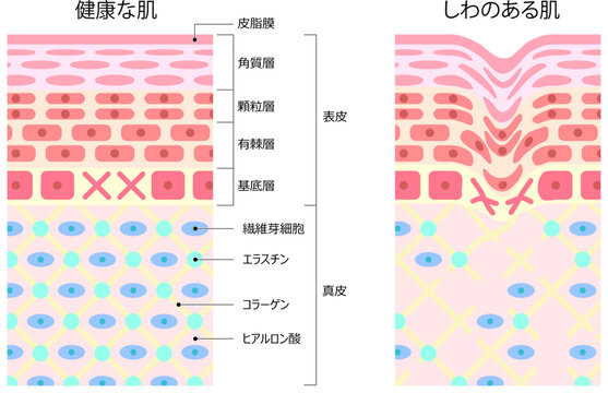 健康な肌としわのある肌の断面図