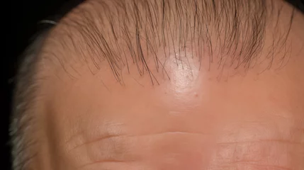 Foto op Canvas close up of a forehead of a person before hair implant treatment © Cavan