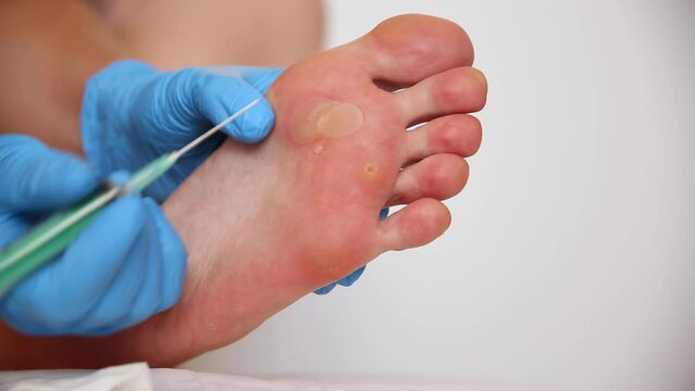 The doctor pierces a callus on the patient s sole with a syringe from which liquid flows, close-up. Copy space for text