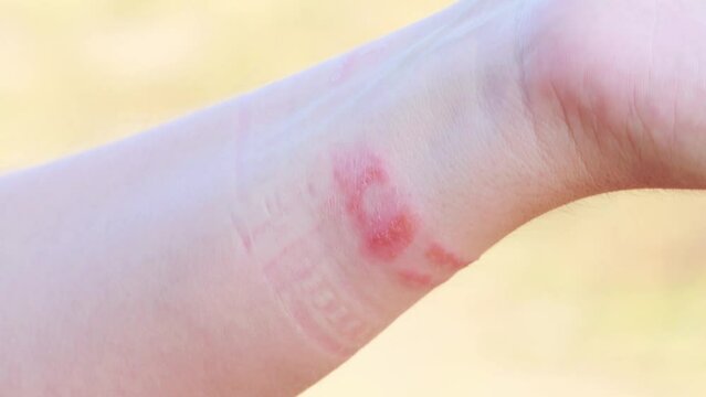 A fitness bracelet with a silicone strap taken from a person s hand. Redness, irritation and itching on the hand from the watch strap. Allergic contact dermatitis, close-up