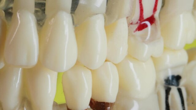 Tooth canals on a medical dental jaw, close-up. Concept for treatment of pulpitis and toothache. Dental implants, macro