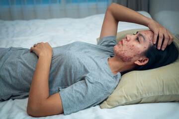 Pillows Cause Acne, Acne on Your face might be suffering when you rest your head upon your pillow night after night.