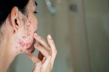 Acne on face because the disorders of sebaceous glands productions.  Acne or a Cosmetic Allergy....