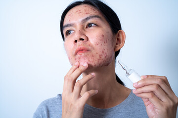Acne on face because the disorders of sebaceous glands productions.  Acne or a Cosmetic Allergy....