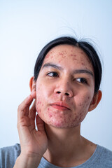 Acne on face because the disorders of sebaceous glands productions.  Acne or a Cosmetic Allergy. Hormonal changes and Foods Cause Symptoms of Skin Allergies