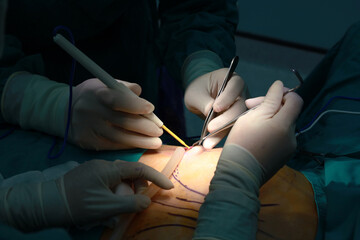 The doctor is performing the surgery For breast augmentation in the operating room