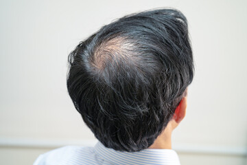 Bald in the middle head and begin no loss hair glabrous of mature Asian business smart active...