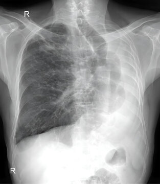 X-ray image of the chest can reveal various lung diseases and abnormalities. 