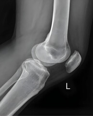 This lateral X-ray magnificently captures the complex anatomy of the knee joint. The image reveals...