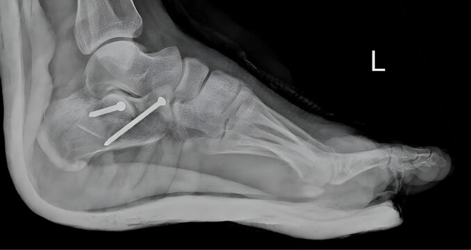 X-ray image of a calcaneus (heel bone) fracture treated with screw fixation