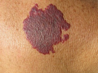 A port-wine stain or naevus flammeus is a vascular birthmark consisting of superficial and deep dilated capillaries in the skin which produce a reddish to purplish discolouration of the skin.