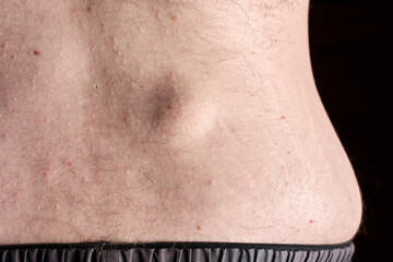 Small round lipoma on the lower back of young caucasian man against dark black background