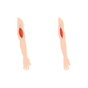 Duchenne Muscular Dystrophy (DMD) Scientific Design. Vector Illustration.