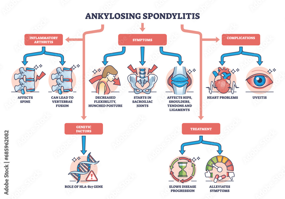 Sticker Ankylosing spondylitis as arthritis symptoms or complications outline diagram. Labeled educational medical scheme with spine inflammation illness and condition vector illustration. Back bone disease.