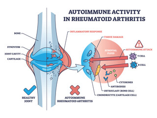 Autoimmune activity in rheumatoid arthritis skeletal disease outline diagram. Labeled educational scheme with body immune system attack to tissues with cells vector illustration. Bone inflammation. - obrazy, fototapety, plakaty
