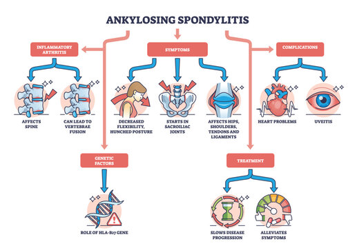 Ankylosing spondylitis as arthritis symptoms or complications outline diagram. Labeled educational medical scheme with spine inflammation illness and condition vector illustration. Back bone disease.