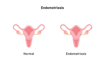 Endometriosis Scientific Design. Vector Illustration.