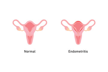 Endometritis Scientific Design. Vector Illustration.