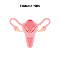 Endometritis Scientific Design. Vector Illustration.