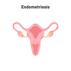 Endometriosis Scientific Design. Vector Illustration.