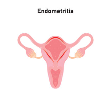 Endometritis Scientific Design. Vector Illustration.