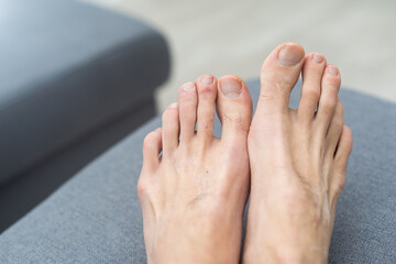 Fototapeta premium Young white male hairy foot with uncared toe nails