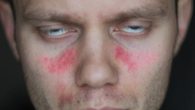 lupus disease, an autoimmune disease, symptoms in the form of redness on the face of a man.