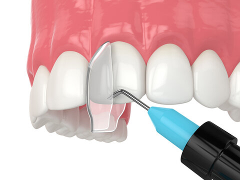 3d render of crooked tooth treatment using bonding procedure