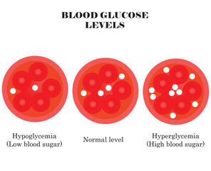 Blood glucose levels. Diabetes: hypoglycemia and hyperglycemia. Vector illustration.