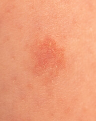 Fototapeta premium Close-up of a wound on the skin. Macro