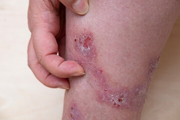 rash, hives, itchy skin on leg, inflammation and Medical Allergies, disease female patient,...