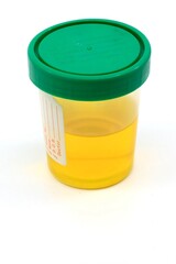 Urine sample for drug testing at a health clinic