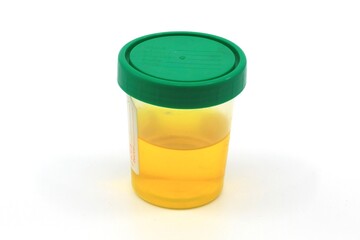 Urine sample
